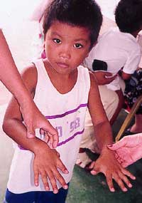 Little boy with six fingers awaiting surgery