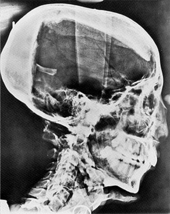 x-ray of the head of Tutankhamen