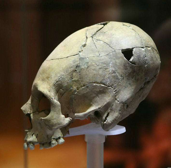elongated skull from Antakya
