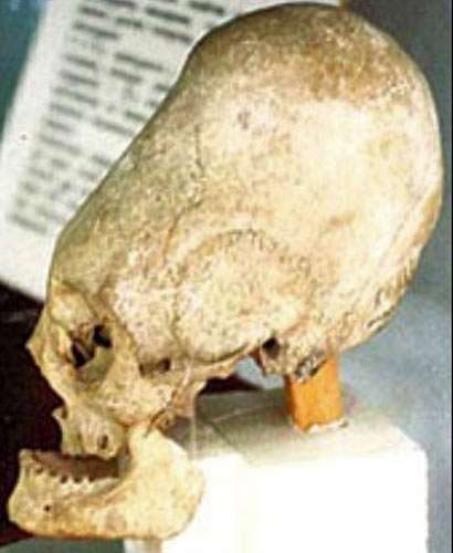 The Pyatigorsk elongated skull
