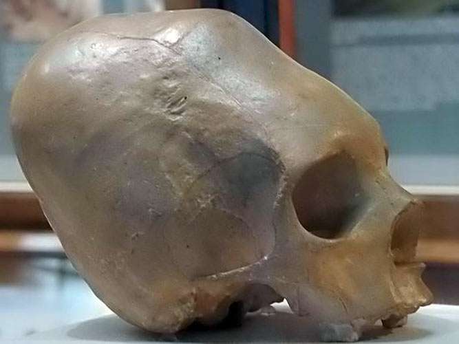 elongated skull in Vienna