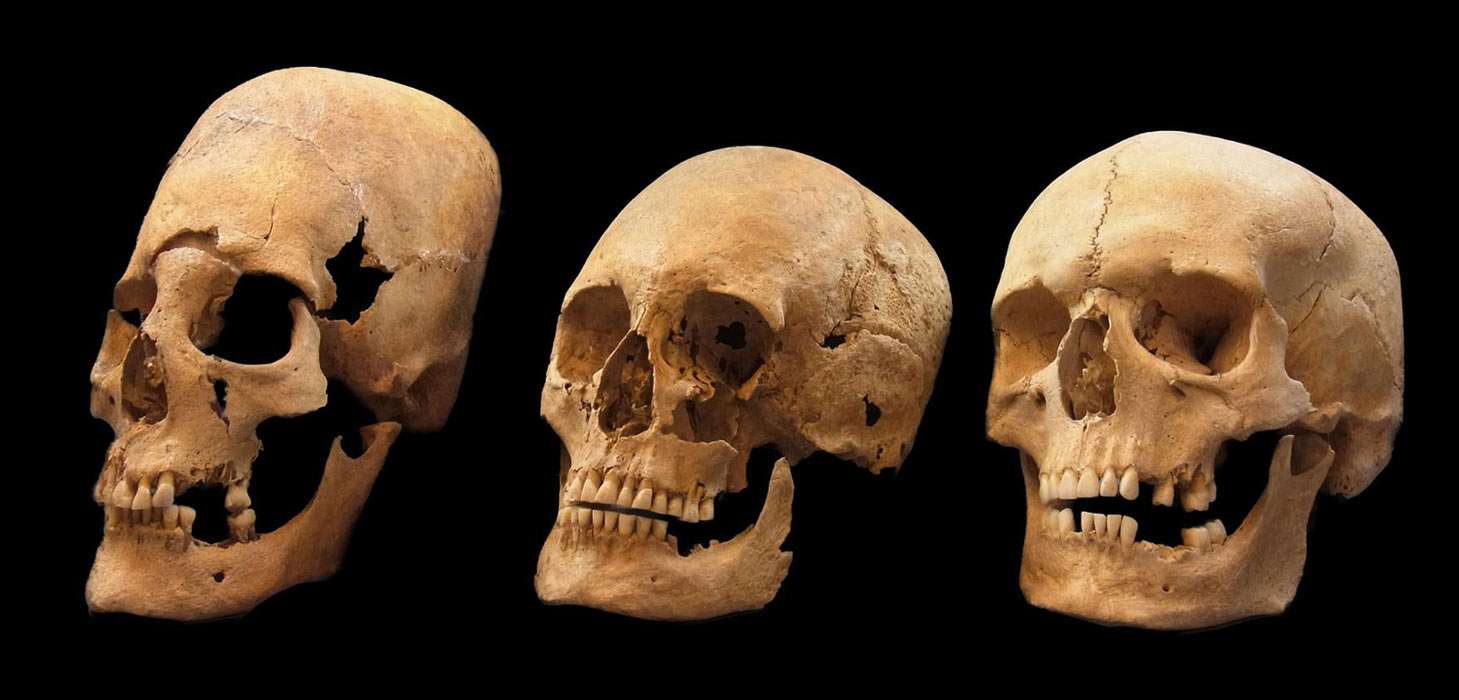 Bavaraian skulls with one elonagated 'tower' variety female skull