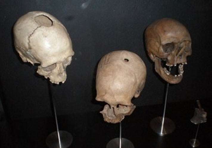 trepanned skulls from Copenhagen