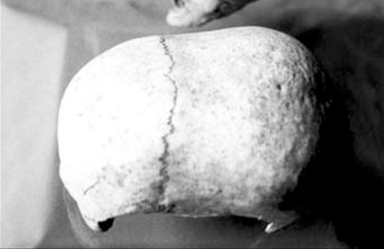elongated skull from Malta