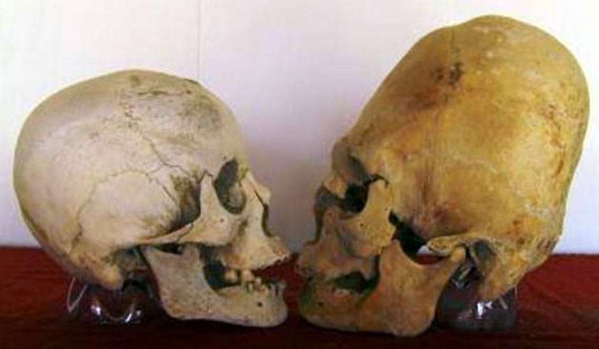 Comparison of skull volume between a normal and elogated skull