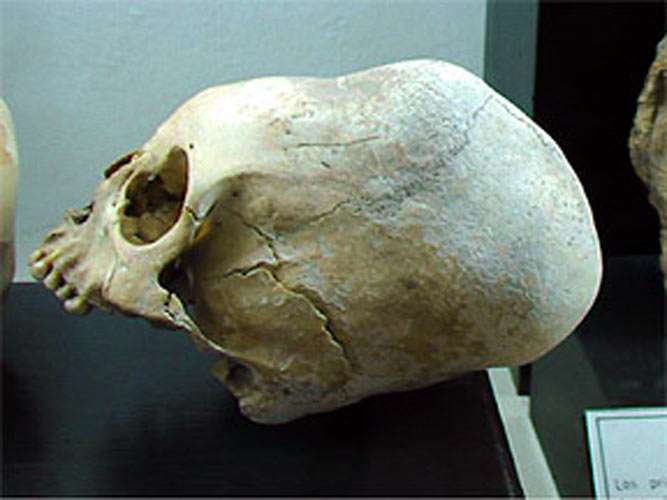 elongated skull from Huarez