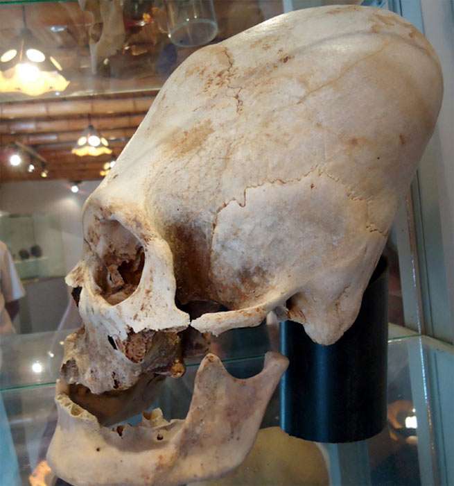 elongated skull from Ica