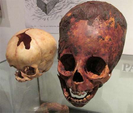 Paracas child compared with normal human child of the same age