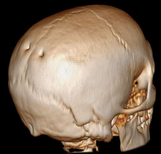 parietal foramen with human skull