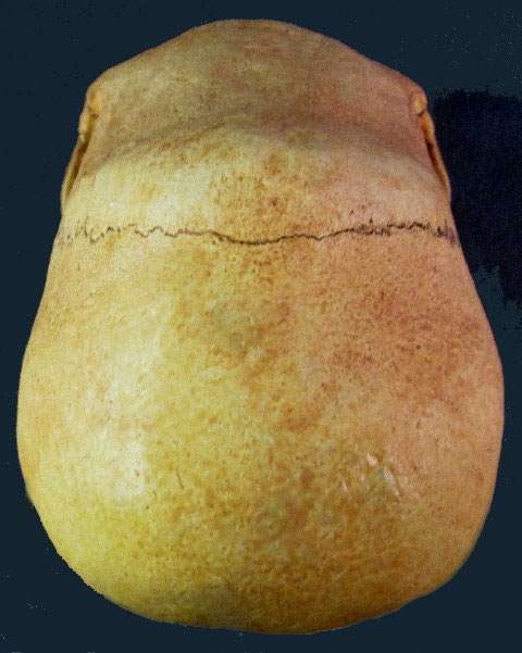 missing sagittal suture on Peru skull