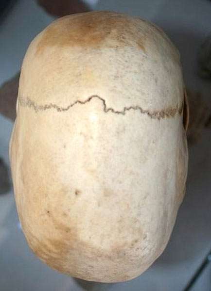 a Paracas skull with missing sagittal suture