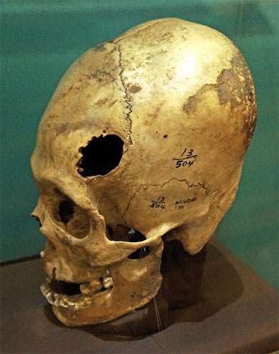 trepanned skull from Paracas